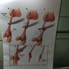 Autoligering inden excision af testikel
Gennem hver sit hul i scrotum
Ingen suturering