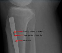 The portion of the long slot hole labeled A is the dynamic interlocking site because it allows the proximal tibia to collapse with weight bearing. Placement of an interlocking screw in holes B or C would lead to static locking of the nail. an1

 