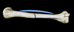 Placing a concave bend in the plate during compressive plating results in compressive forces at both the near and far cortices (Illustration A). As described in the AO manual of fracture fixation, this technical pearl helps to ensure that osteosyn...