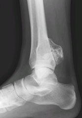 on the surface of the bone especially the sites of tendon insertions , and locations include knee, in the proximal femur, proximal humerus ,subungal exostosis occurs most often at the hallux