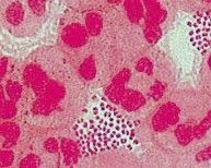  Neisseria gonorrhea
Does not require surgery large doses of PENICILLIN alone to treat
gram-negative coccus usually intracellular in neutrophils