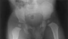  A 10-month-old infant is brought to the emergency department for fevers, irritability, and avoidance of motion in the right leg. On physical exam, passive motion of the right hip elicits crying. An AP pelvis and an ultrasound of the right hip ar...