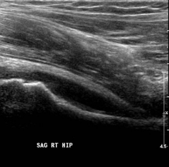 The clinical scenario is consistent with a pediatric septic hip. The AP pelvis in figure A shows soft-tissue swelling with mild subluxation of the right hip due to a septic effusion, and the ultrasound in figure B also shows a hip effusion. The hi...