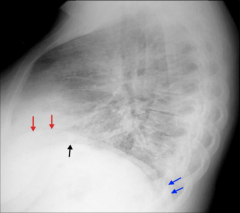 - the left hemi-diaphragm is usually lower than the right 
- also, since the heart lies prdominately on the left side the result on a lateral film is sihouetting 