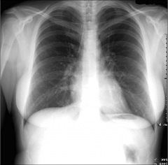 - the diaphragm should be found at about the level of the 8th - 10th posterior rib on a good inspiration
- make sure there's a good inhalation
- you can tell if it's a poor inspiration if there are more than 10 ribs in the x-ray 
