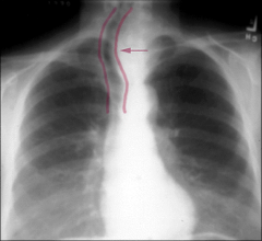 - this image shows a goiter that has displaced the trachea evidenced by the shift in the chracteristic air- shadow 
- a patient with a goiter will show tracheal deviation on an x-ray 
