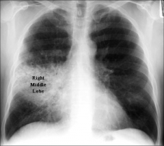 - occurs with the loss of lung tissue due to mass or fluid 
- if you have an opacity next to the heart border then the opacity will opacity will obscure the border 
- you see right middle lobe consolidation sihouette sign here 