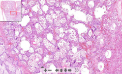 - Lung tissue
- Violet calcification in capillary walls of alveoli septa