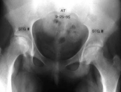 patient complains of pain going upstairs, insidious onset, pain anteriorly what is the diagnosis
what percent of patients with this diagnosis are bilateral
What is a rate AVN with a basicervical fracture of the hip