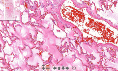 - Lung tissue
- Pinkish edematous stuff inside alveoli
- RBC congestion in septa

ETIOLOGY