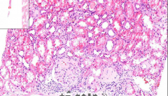 - Kidney tissue (thin streak)
- Some pinkish material deposited in glomeruli
- Thicker walls of glomeruli vessels

ETIOLOGY
