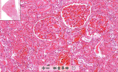 - Kidney tissue & large glomeruli
- Pink homogenous thrombi in glomeruli

ETIOLOGY