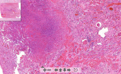 - Kidney tissue
- Abscesses in cortex
- Scattered neutrophils
- Bacterial basophilic thrombi in glomerulus (bacterial colony) - black

ETIOLOGY