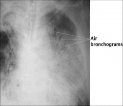 - air bronchogram is a tubular outline of an airway made visible by filling the surrounding alveoli by fluid or inflammatory exudate 


- this picture shows outline of alveoli 


 