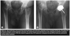 proximal femoral deformity making total hip difficulty
High risk of sepsis due to prior infection or immunosuppression
Neuromuscular disease
young male with good bone stock
Bone stock deficiency of the femoral head or neck that is cystic degenerat...