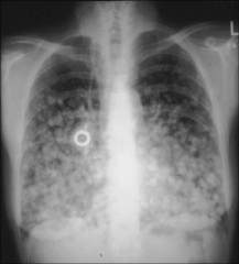 - you see differentiation here 


- you do not see differentiation during pleural edema 