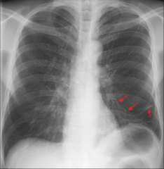 - atelectasis is collapse or incomplete expansion of the lung or part of the lung 


- increase in density 


- raised diaphgragm on the effected side (volume loss) 


-loss of fluid volume, diaphragm pulled up a bit 
