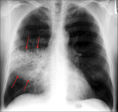 - pneumonia is airspace disease and consolidation


- air spaces are filled with bacteria or other microorganisms and pus 


- there is no volume loss as seen in atelectasis 