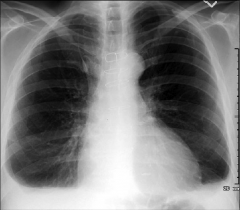 - blunting of costophrenic sulci 


- the fluid goes to the base of the lungs due to gravity 


- depression of the diaphragm may occur as seen here 


- approx. 200 ml of fluid are needed to detect an effusion in the frontal film vs. app...