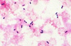 Who am I?


What disease to I cause?


PS: - Gram positive, Large lancet-shaped diplococci, have a polysaccharide capsule