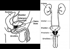 *Prostatic enlargement; urethral obstruction.