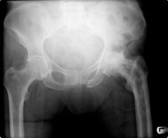A 67-year-old male patient is scheduled for left total hip arthroplasty. A pre-operative examination reveals elevated serum alkaline phosphatase and urine hydroxyproline. A radiograph of his hip/pelvis is seen in Figure A. Taking into context the ...