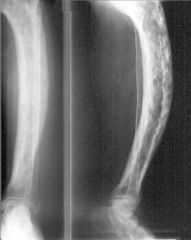 was the treatment of a fracture through a pathologic bowing of the long bone