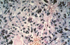 Patients with Paget's disease are predisposed to secondary osteosarcoma, chondrosarcoma, and spindle cell sarcoma of bone (e.g. fibrosarcoma) all which can occur through Pagetoid lesions. 



Huvos describes their clinical analysis of 117 patie...