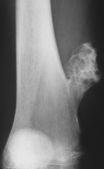 osteochondroma, there may be a cartilaginous cap over the lesion 2-3 mm thick, normal primary trabeculated well defined perichondrium
observe and asymptomatic patient's however this patient complained of mechanical symptoms discussed the treatment...