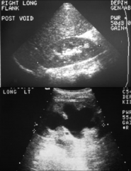 *Top: Normal ultrasound.
*Bottom: Hydronephrosis.