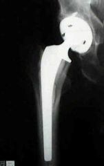 A 75-year-old man who underwent total hip arthroplasty 20 years ago now complains of thigh pain for the past four months. Laboratory studies show a normal white blood cell count (WBC), erythrocyte sedimentation rate (ESR) and C-reactive protein (C...