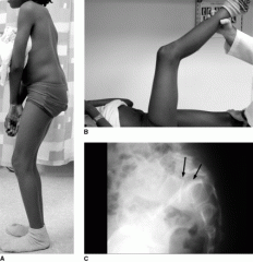 spondylolisthesis secondary to repetitive hyperextension
in this patient treat with physical therapy and activity restriction pain was x-rays show
most common location and its child is L5/S1  compared to and L4/L5
X-rays are negative the best tes...