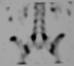 A 13-year-old gymnast reports the acute onset of low back pain that began four weeks ago. Radiographs are unremarkable. A single-photon-emission-computer-tomography (SPECT) is shown in Figure A. Initial treatment should consist of? 


1.  Bra...