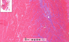 - Cardiac muscle tissue
- Eosinophilic necrotic area with no nuclei
- Zone of demarcation = blue lymphocytes
- See thrombus in endocardium (mural)
- See occluded coronary artery

ETIOLOGY