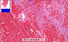 - Irregular low cellular pink fibrotic tissue
- +/- hyalinization

ETIOLOGY