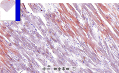 - Cardiac muscle tissue
- Organge droplets within cardiomyocytes (in sarcoplasm)

ETIOLOGY