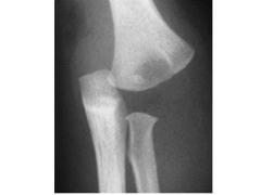 corner fracture affecting the primary spongiosa of the metaphysis
Bucket-handle fracture
transphyseal separation of the distal humerus