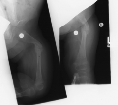 was most common cause of femur fracture in nonambulatory implant