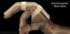 dorsal PIP fracture dislocation
preventing PIP subluxation >articular surface reconstruction
< 40% = dorsal extension block splint
>40% = surgery
dynamic distraction external fixator for comminuted pilon fracture dislocations and arthrodesis for c...