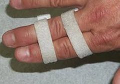 dorsal PIP dislocation
Injury of the volar plate = swan-neck deformity if untreated
Reduction and buddy tape to the adjacent finger