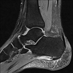 patient has pain 1st steps in the morning when getting out of bed and pain worse at the end of day with prolonged standing, BMI = 35


what is the diagnosis
What 3 muscles share the originon the calcaneus
what is the heel pain triad
What is the ...