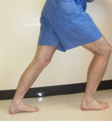 A plantar fascia-specific stretching program has the highest patient satisfaction at the 8 week follow-up interval. Symptoms of plantar fasciitis include “start-up” inferior heel pain with patients often preferring to walk on their toes for th...