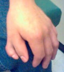 what is the diagnosis
What form of polydactyly as this
Which form is most common
What is the treatment