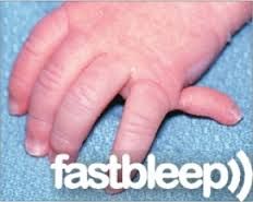 what is the diagnosis
What form of polydactyly
What is the most common patient population affected and we ensured a genetic workup be done