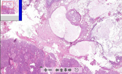 - Normal pancreatic tissue (islets of langerhans, acini) is half of the slide
The rest is messed up:
- White = Adipose tissue = liquefactive necrosis
- Pink = Necrosis
- Dark pink = Zome of demarcation, border of lymphocytes

ETIOLOGY