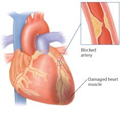 A heart attack; death of heart muscle following obstruction of blood flow to it. Acute in this context means "new" or "happening right now."