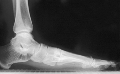 what is the most common cause of the adult acquired flatfoot deformity