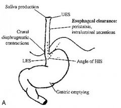 The angle of His - oblique angle of entry of the esophagus into the stomach. 
Absent in infants (2/3rds of 4-month-old infants have reflux)