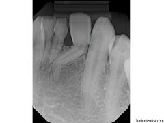 Angular formation of the tooth root as a result of trauma. 

Associated with Rickets and cretinism