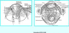 Removal of:
Uterus
Cervix
Upper 1/3-1/2 of vagina
All parametrial and paravaginal tissues to the pelvic wall
Pelvic lymph node dissection often included


Bonus question: What stage(s) of cervical cancer is this operation appropriate for?